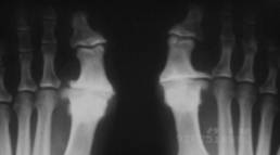 hallux rigidus1