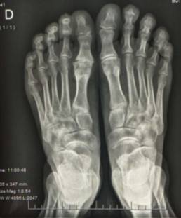 hallux rigidus4