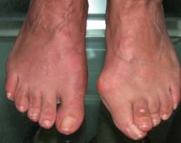 hallux valgus3_ok