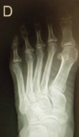 hallux valgus4