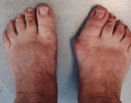 hallux valgus5