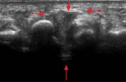 neuroma morton1