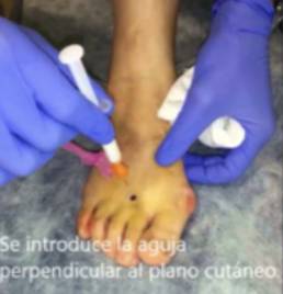 neuroma morton3